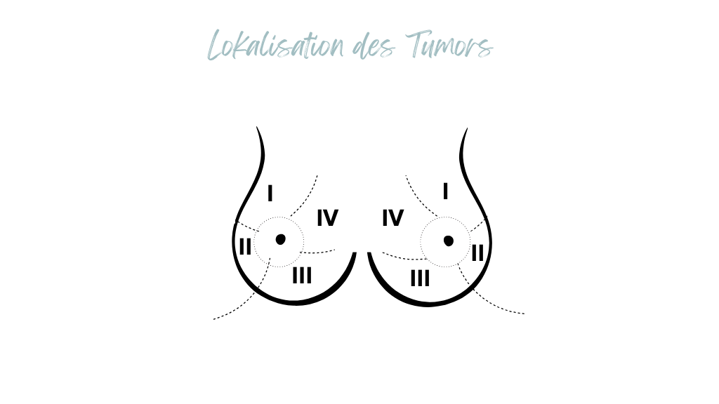 Lokalisation Brusttumor